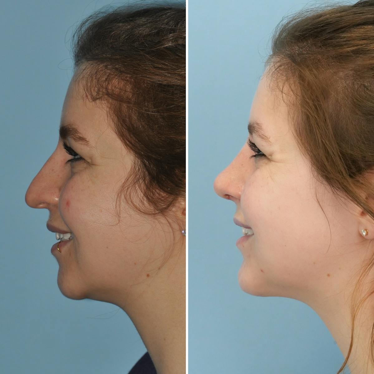Rhinoplasty Before & After Gallery - Patient 723048 - Image 6