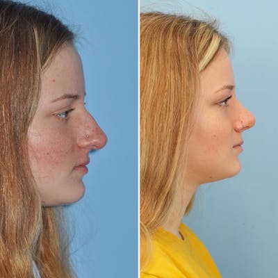 Rhinoplasty Before & After Gallery - Patient 111786 - Image 1