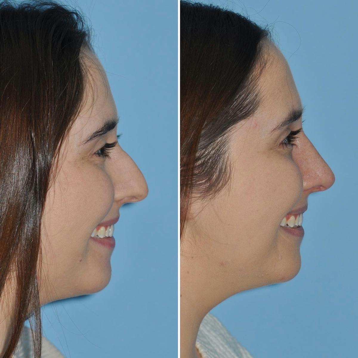 Rhinoplasty Before & After Gallery - Patient 281156 - Image 2