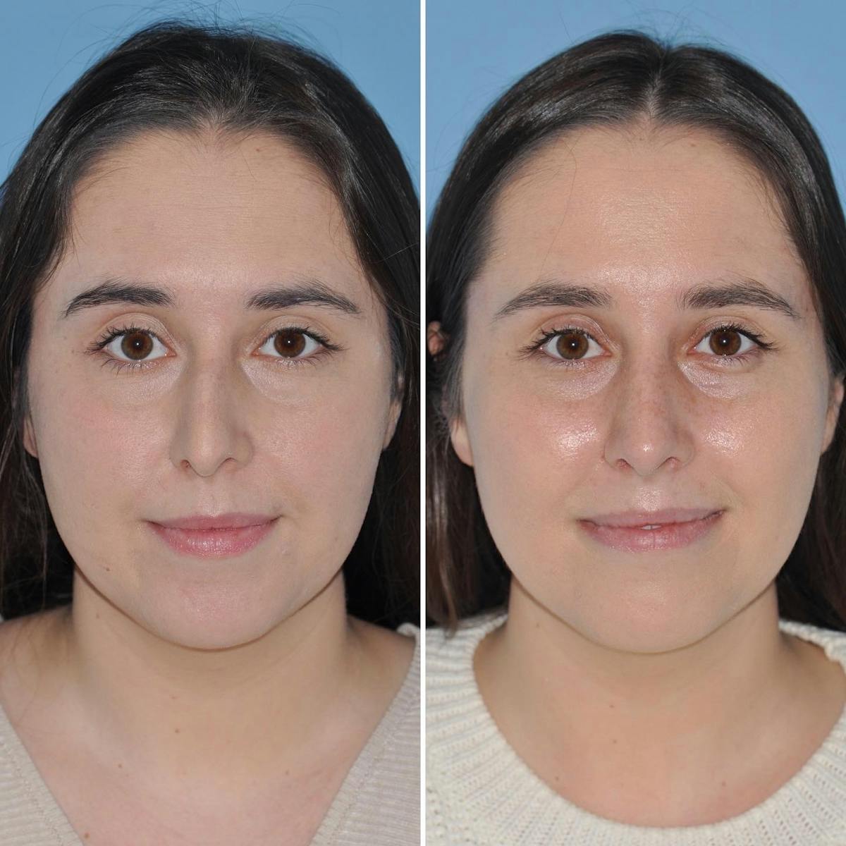 Rhinoplasty Before & After Gallery - Patient 281156 - Image 3