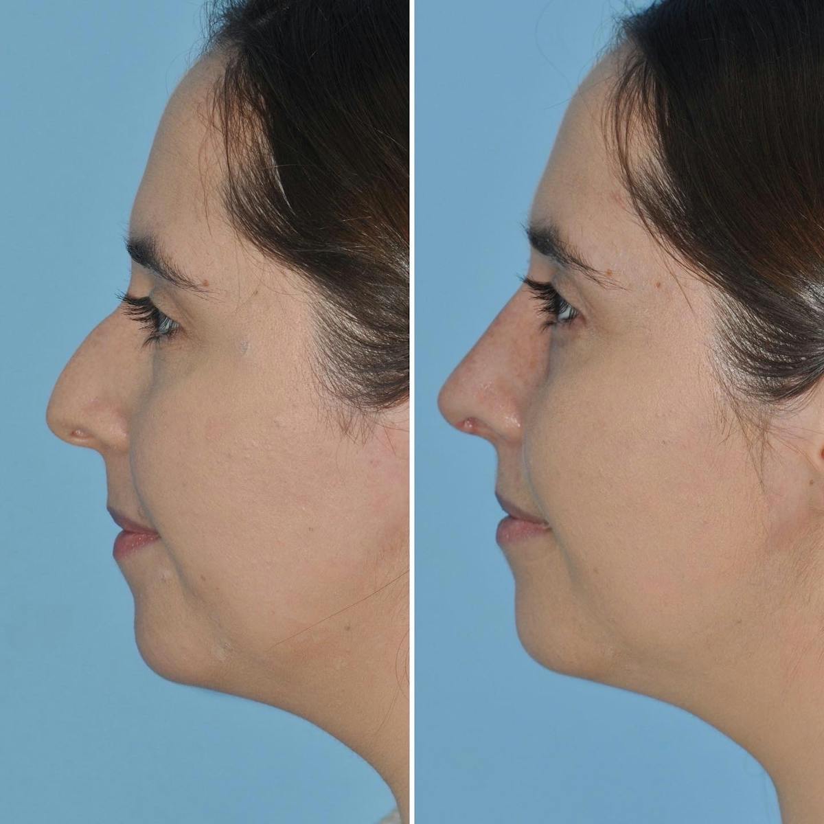 Rhinoplasty Before & After Gallery - Patient 281156 - Image 4