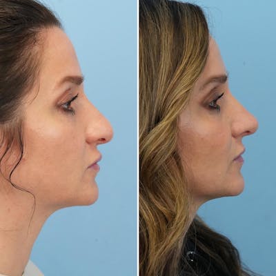 Rhinoplasty Before & After Gallery - Patient 899222 - Image 1