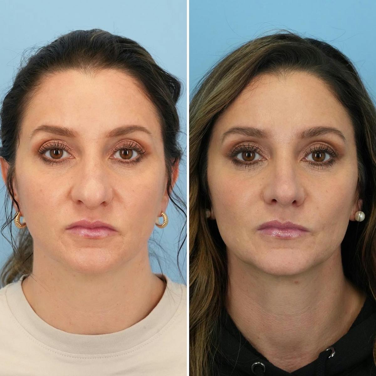 Rhinoplasty Before & After Gallery - Patient 899222 - Image 3