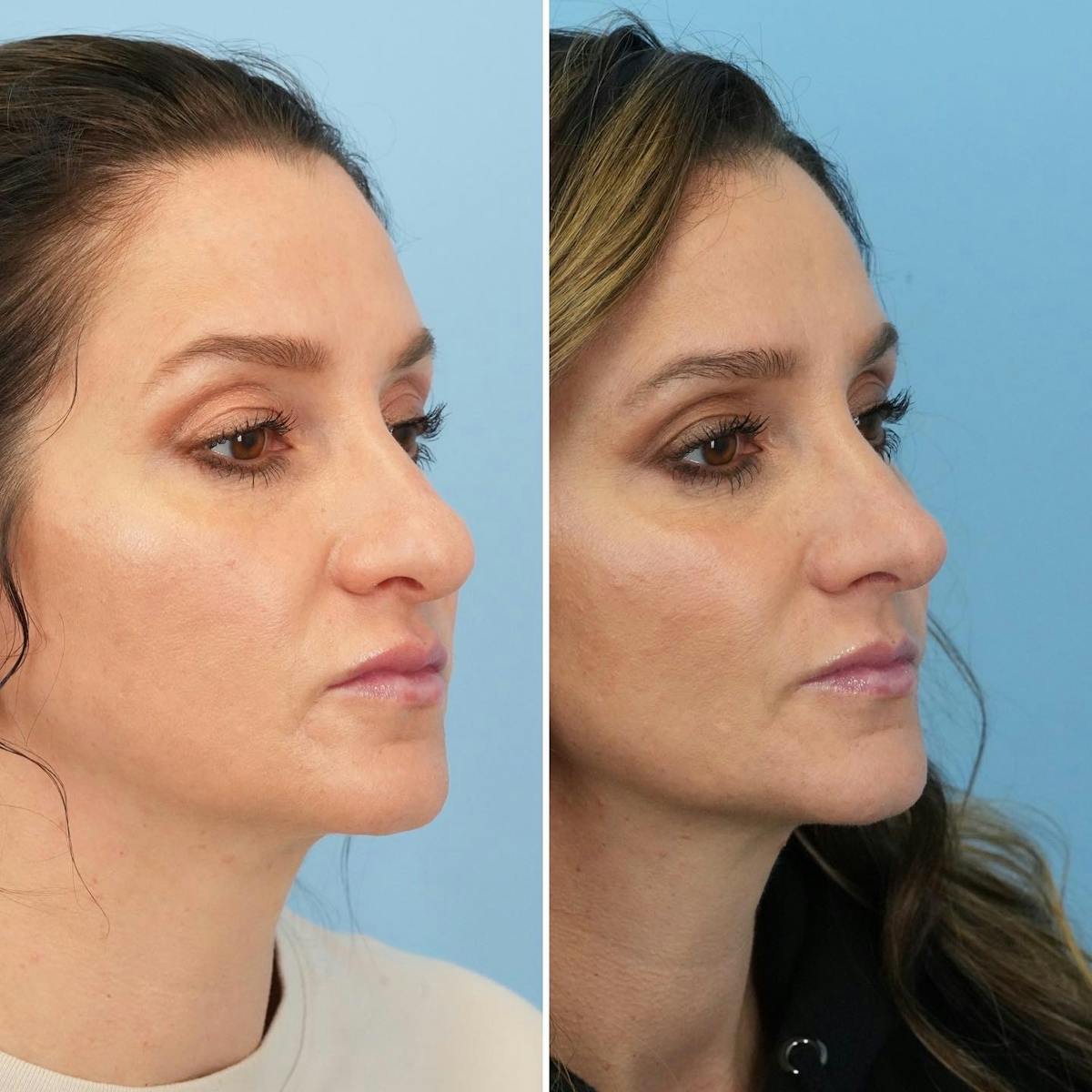 Rhinoplasty Before & After Gallery - Patient 899222 - Image 5