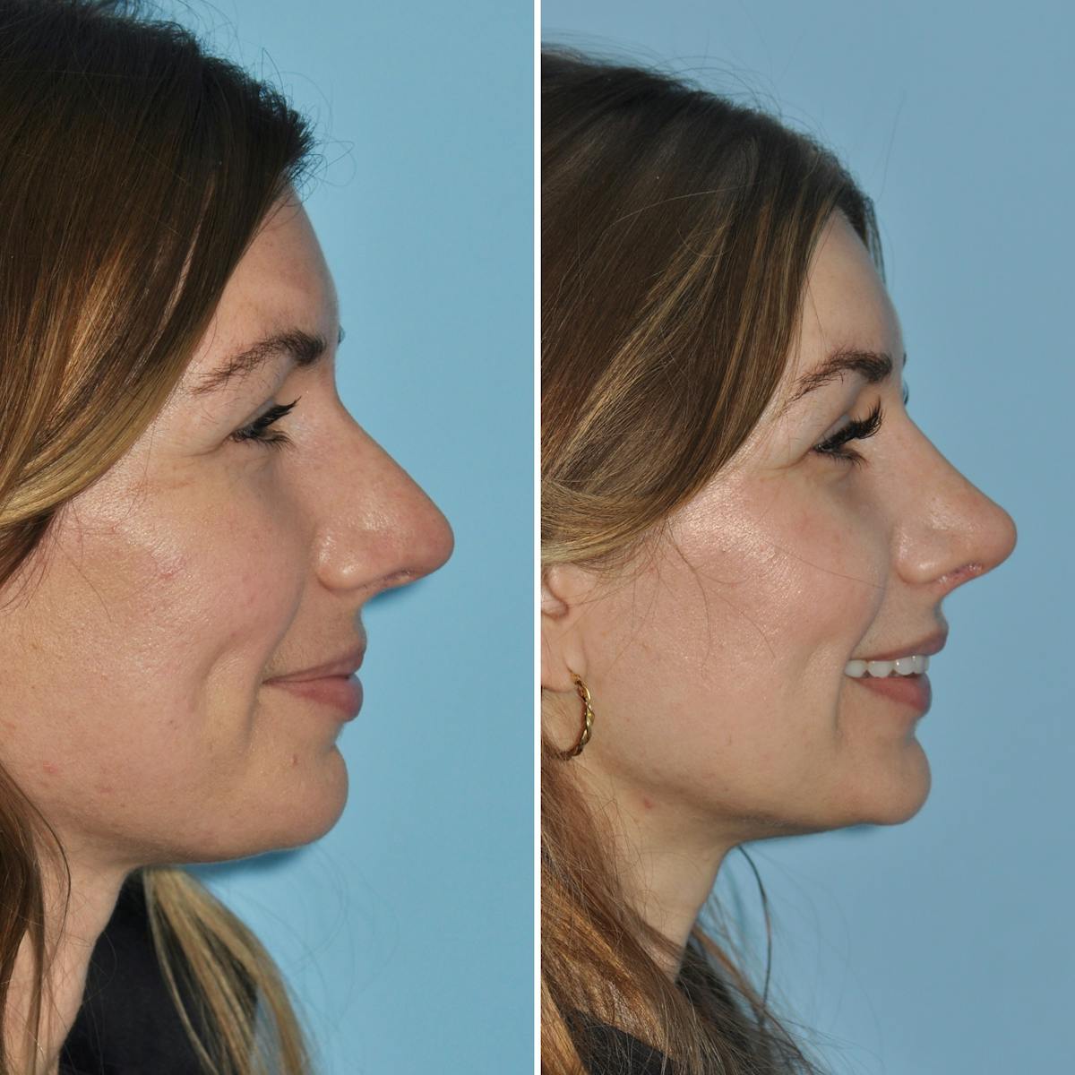 Rhinoplasty Before & After Gallery - Patient 389746 - Image 1