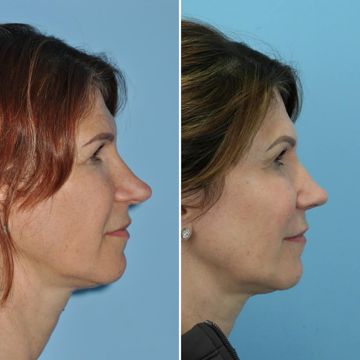 Rhinoplasty Before & After Gallery - Patient 271101 - Image 1