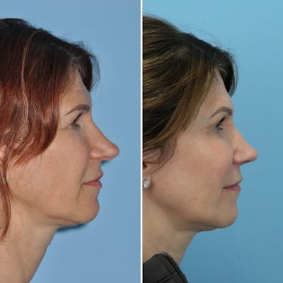 Rhinoplasty Before & After Gallery - Patient 271101 - Image 1