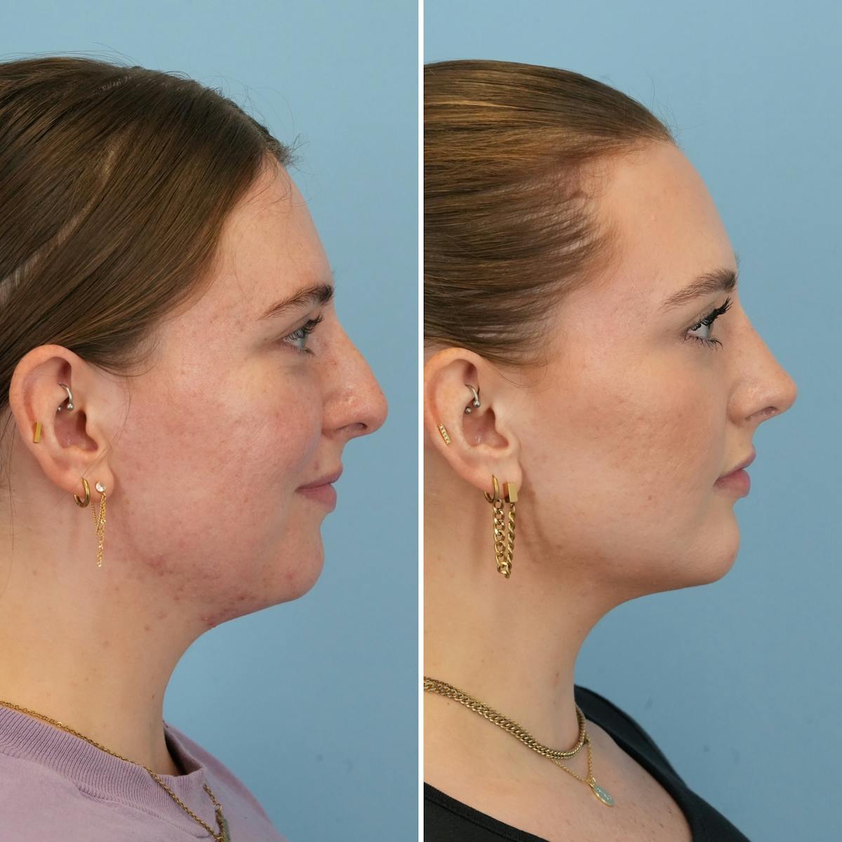 Rhinoplasty Before & After Gallery - Patient 985982 - Image 1