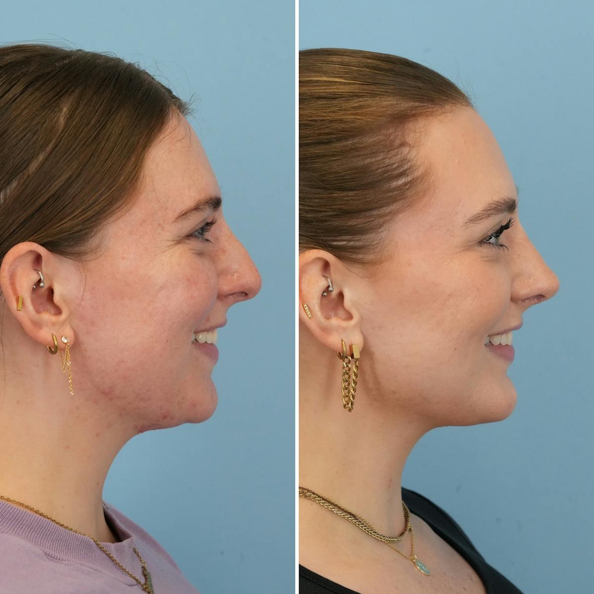 Rhinoplasty Before & After Gallery - Patient 985982 - Image 2