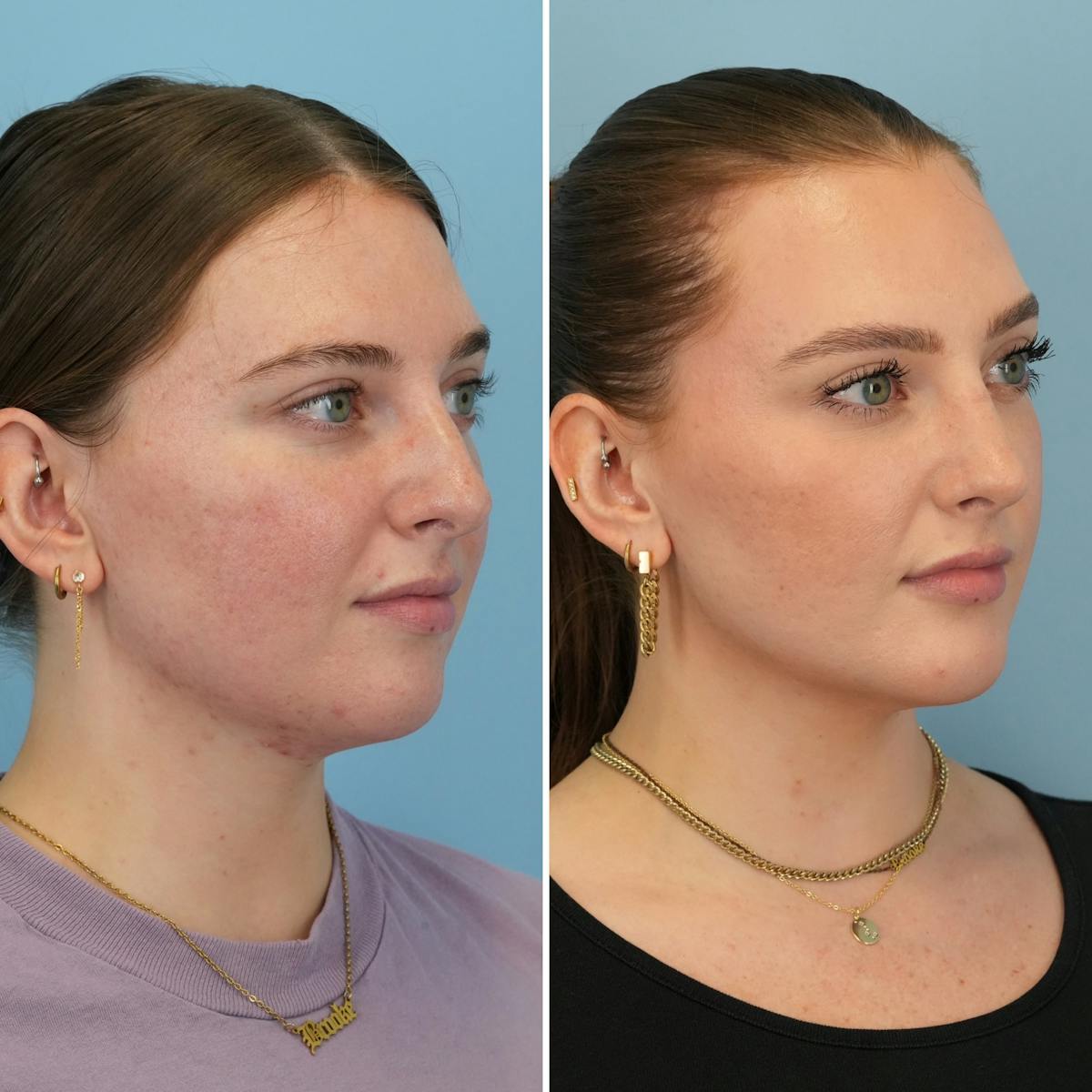 Rhinoplasty Before & After Gallery - Patient 985982 - Image 3