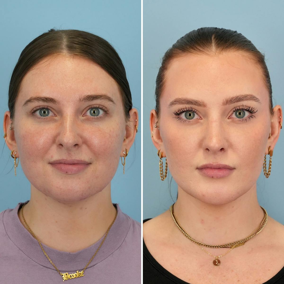 Rhinoplasty Before & After Gallery - Patient 985982 - Image 4