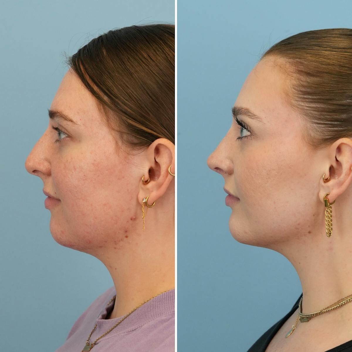 Rhinoplasty Before & After Gallery - Patient 985982 - Image 7
