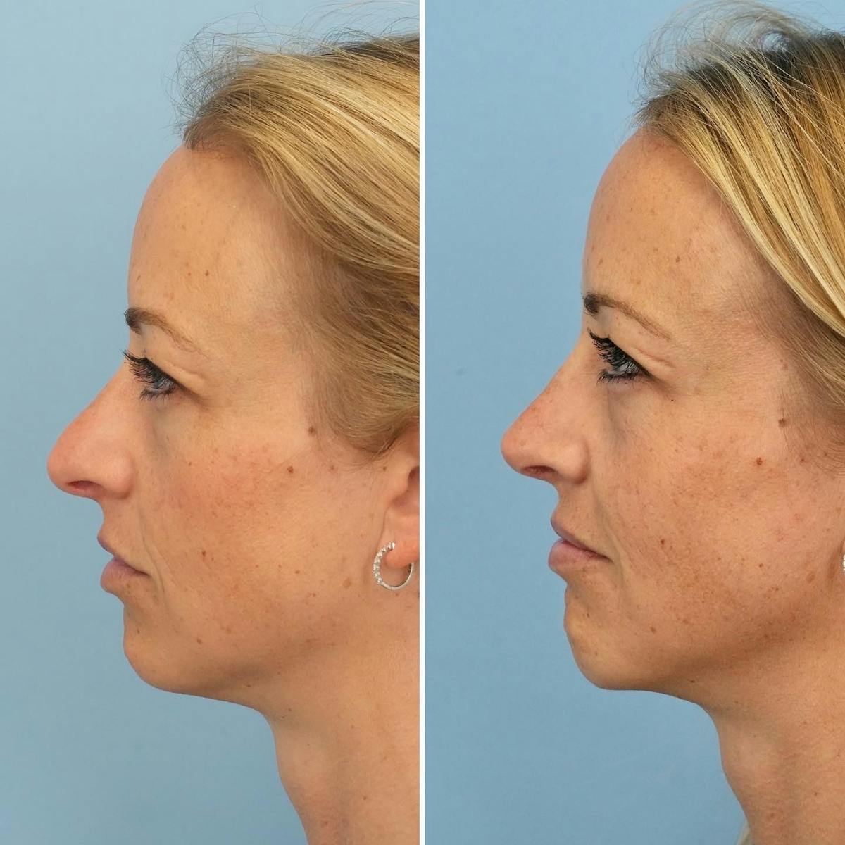 Rhinoplasty Before & After Gallery - Patient 624716 - Image 1
