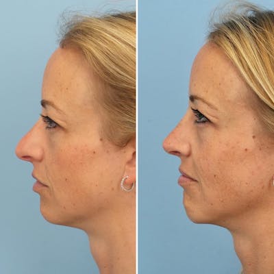 Rhinoplasty Before & After Gallery - Patient 624716 - Image 1