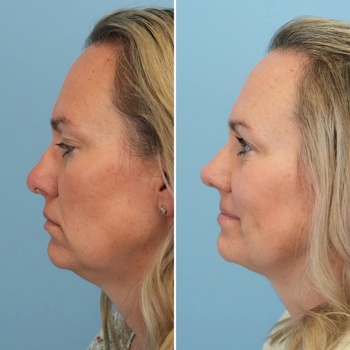 Rhinoplasty Before & After Gallery - Patient 789541 - Image 1