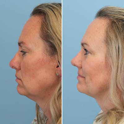 Rhinoplasty Before & After Gallery - Patient 789541 - Image 1