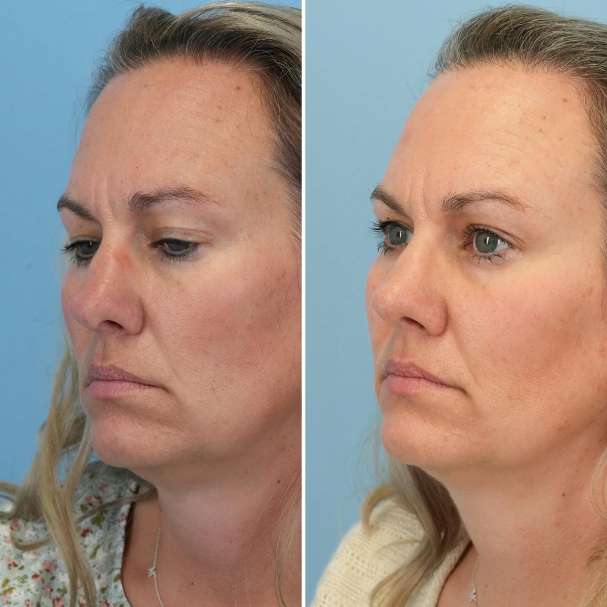Rhinoplasty Before & After Gallery - Patient 789541 - Image 2