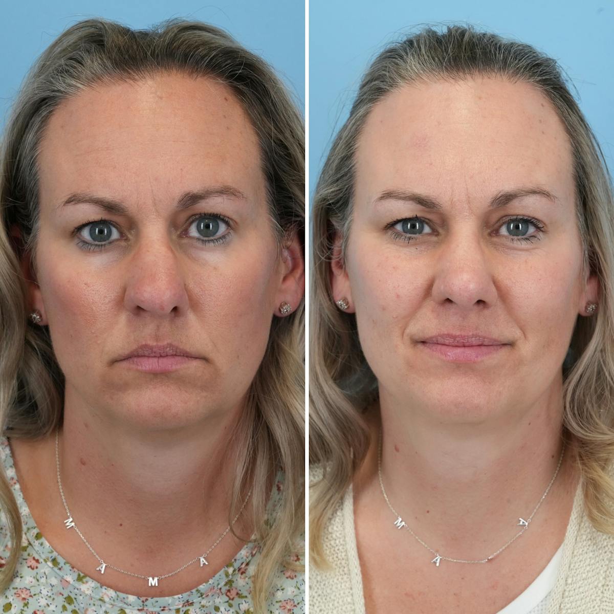 Rhinoplasty Before & After Gallery - Patient 789541 - Image 3