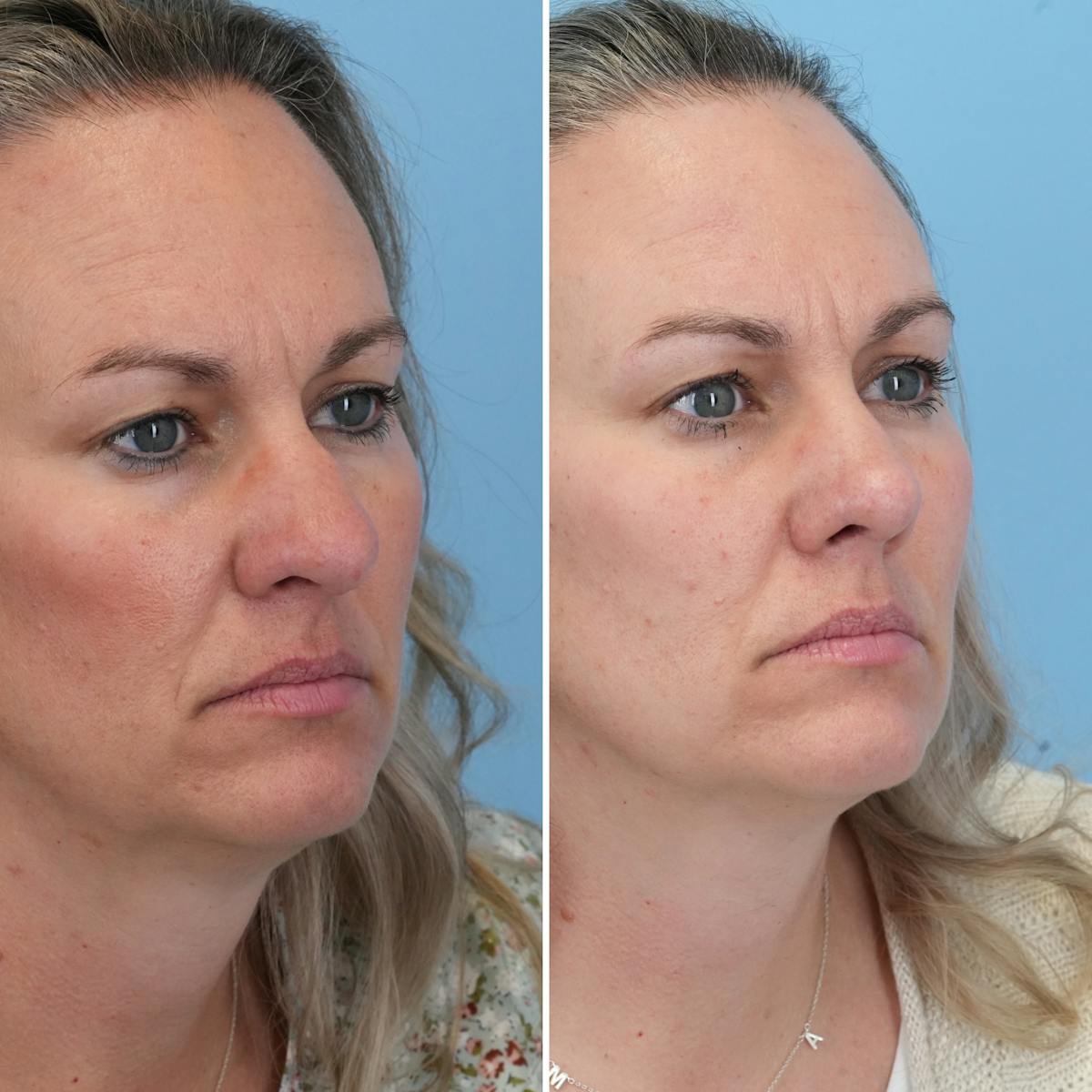 Rhinoplasty Before & After Gallery - Patient 789541 - Image 4