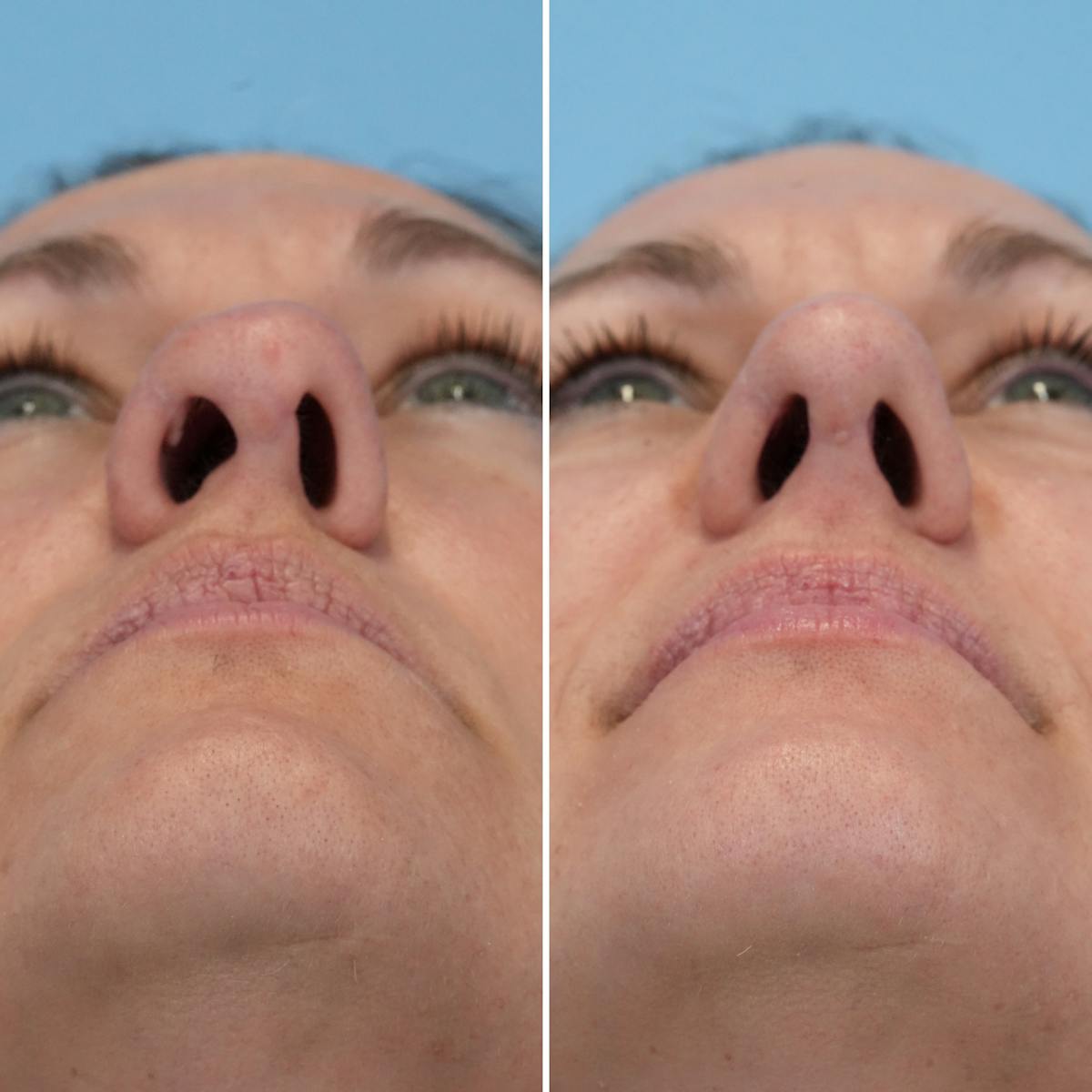 Rhinoplasty Before & After Gallery - Patient 789541 - Image 5