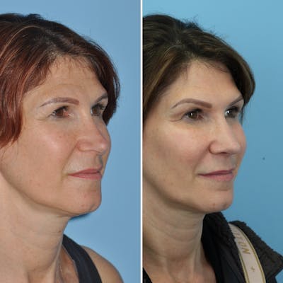Rhinoplasty Before & After Gallery - Patient 119984 - Image 1