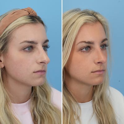 Rhinoplasty Before & After Gallery - Patient 844436 - Image 1
