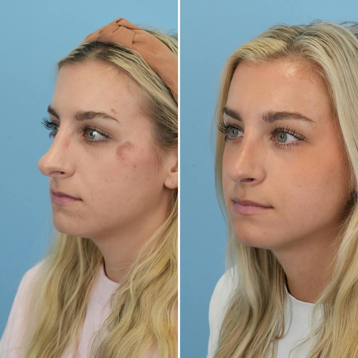 Rhinoplasty Before & After Gallery - Patient 844436 - Image 2