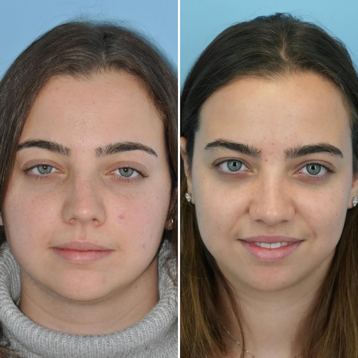Rhinoplasty Before & After Gallery - Patient 281161 - Image 2