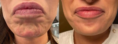 Botox/Dysport Before & After Gallery - Patient 120405 - Image 1