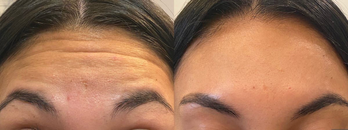 Botox/Dysport Before & After Gallery - Patient 322112 - Image 1