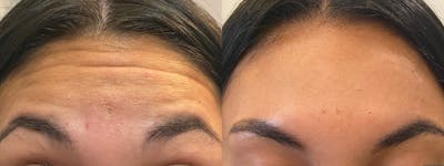 Botox/Dysport Before & After Gallery - Patient 322112 - Image 1