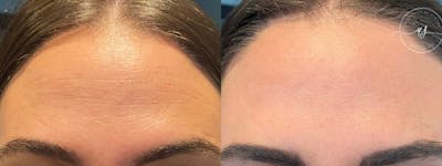 Botox/Dysport Before & After Gallery - Patient 615982 - Image 1