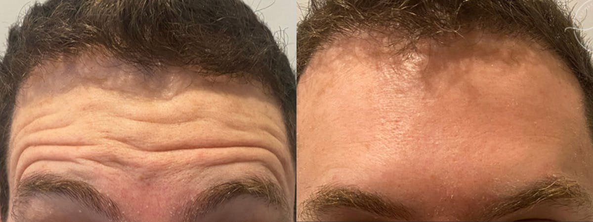 Botox/Dysport Before & After Gallery - Patient 146640 - Image 1