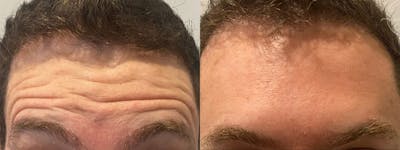Botox/Dysport Before & After Gallery - Patient 146640 - Image 1