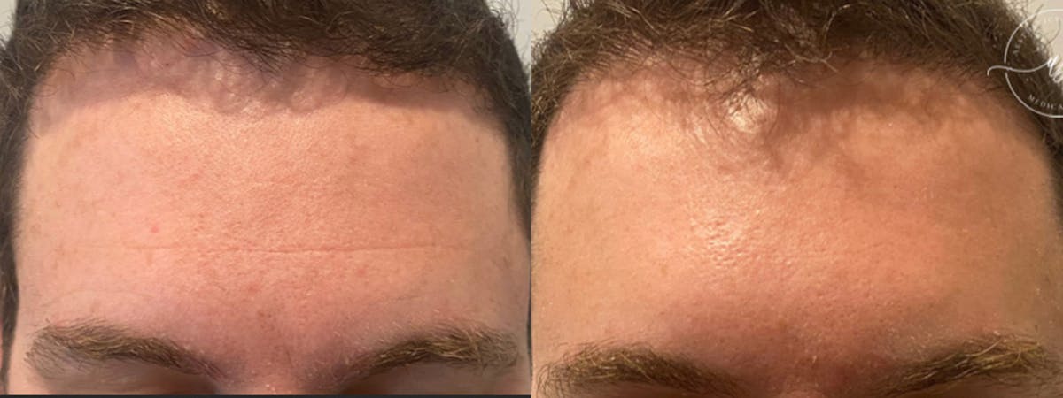 Botox/Dysport Before & After Gallery - Patient 146640 - Image 2