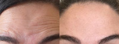 Botox/Dysport Before & After Gallery - Patient 813590 - Image 1