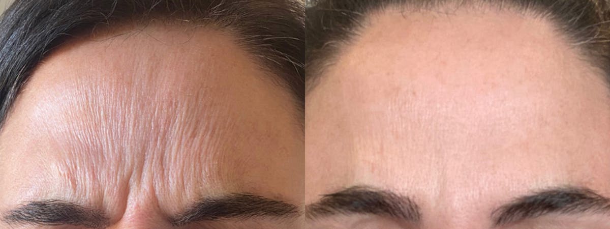 Botox/Dysport Before & After Gallery - Patient 813590 - Image 2