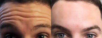 Botox/Dysport Before & After Gallery - Patient 219564 - Image 1
