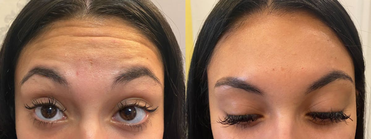 Botox/Dysport Before & After Gallery - Patient 376502 - Image 1