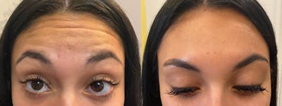 Botox/Dysport Before & After Gallery - Patient 376502 - Image 1