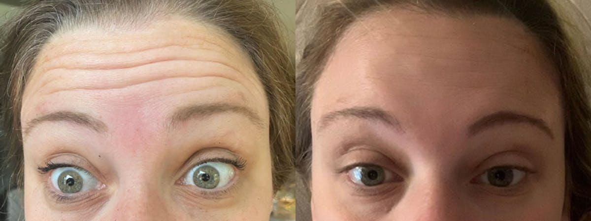 Botox/Dysport Before & After Gallery - Patient 148493 - Image 1