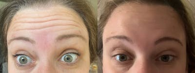 Botox/Dysport Before & After Gallery - Patient 148493 - Image 1