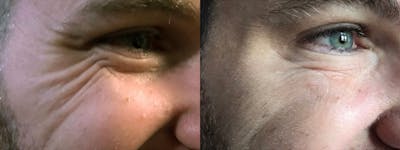 Botox/Dysport Before & After Gallery - Patient 219301 - Image 1