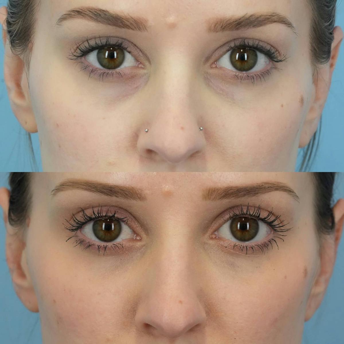 Dermal Fillers Before & After Gallery - Patient 145104 - Image 1