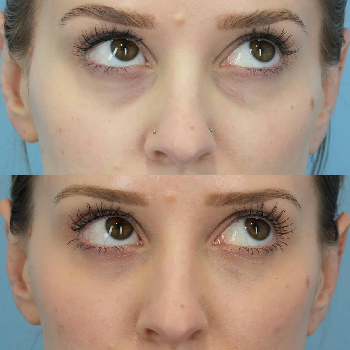 Dermal Fillers Before & After Gallery - Patient 145104 - Image 2