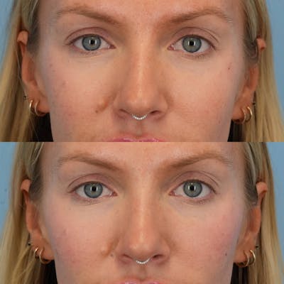 Dermal Fillers Before & After Gallery - Patient 706048 - Image 1