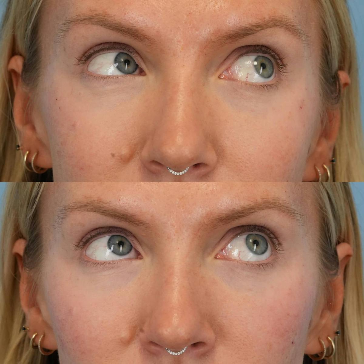 Dermal Fillers Before & After Gallery - Patient 706048 - Image 4