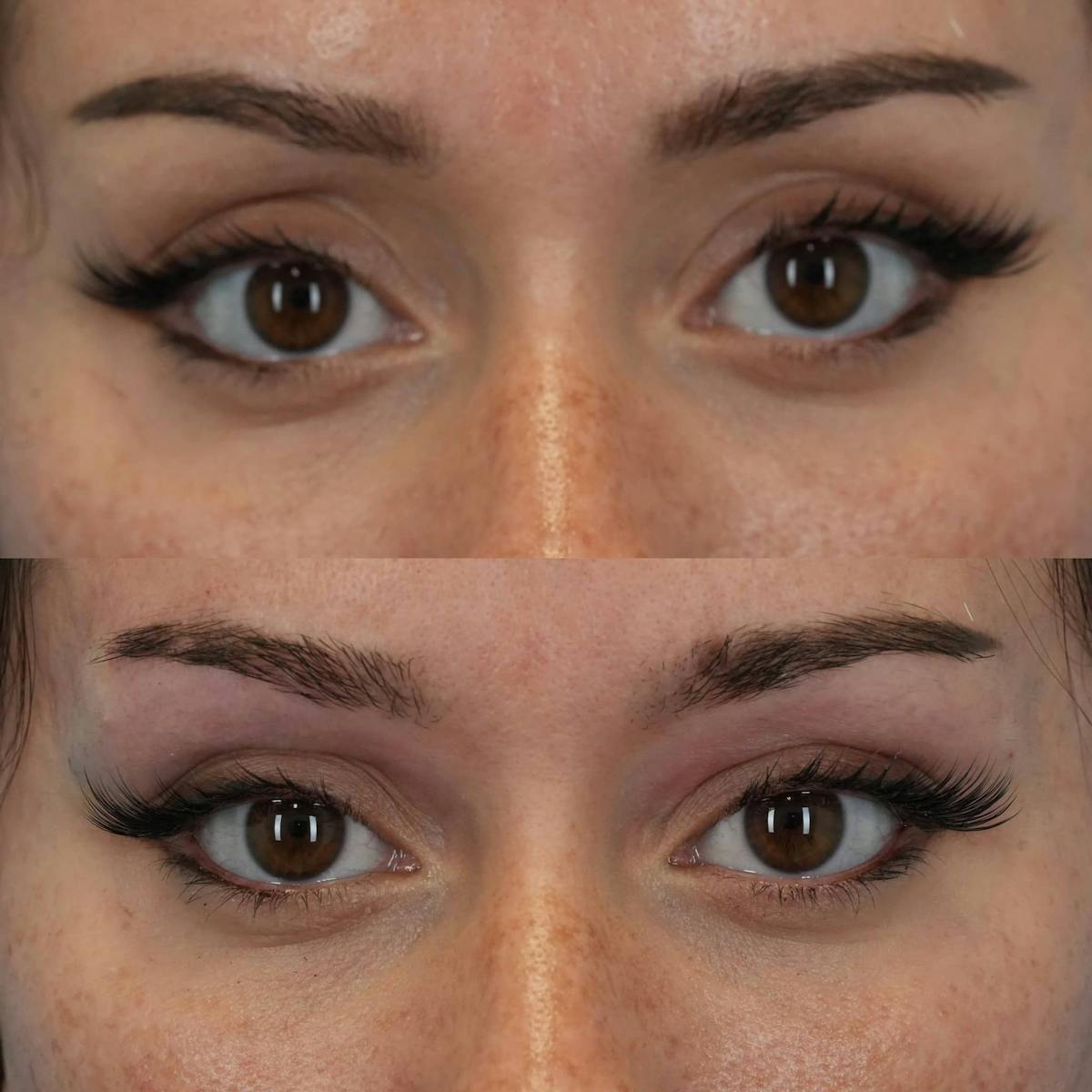 Dermal Fillers Before & After Gallery - Patient 193293 - Image 1
