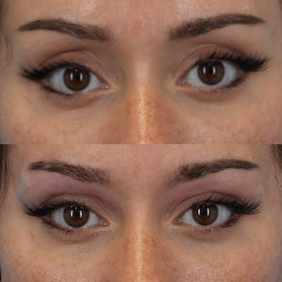 Dermal Fillers Before & After Gallery - Patient 193293 - Image 1