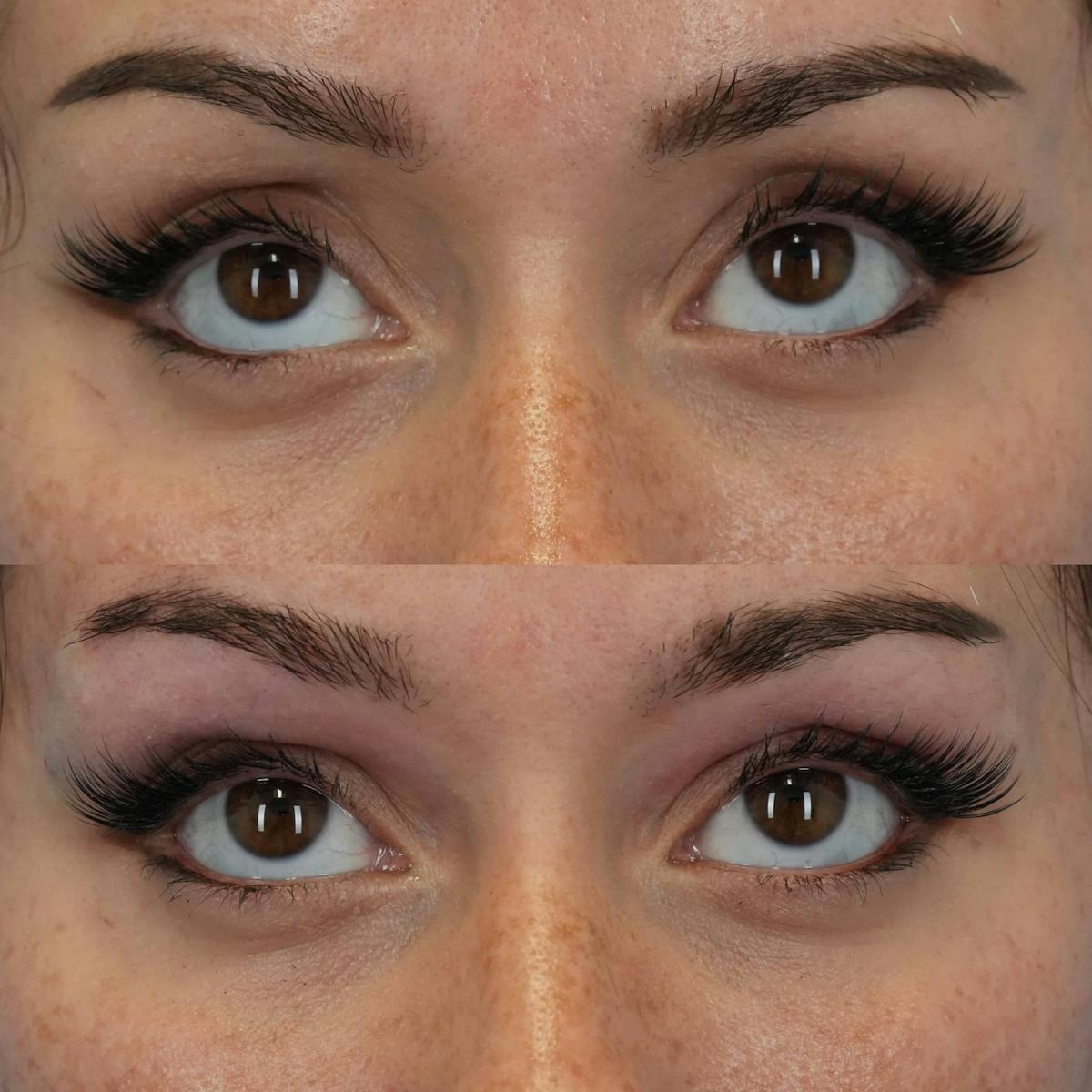 Dermal Fillers Before & After Gallery - Patient 193293 - Image 2